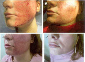 Various stages of skin recovery after ablation surgery