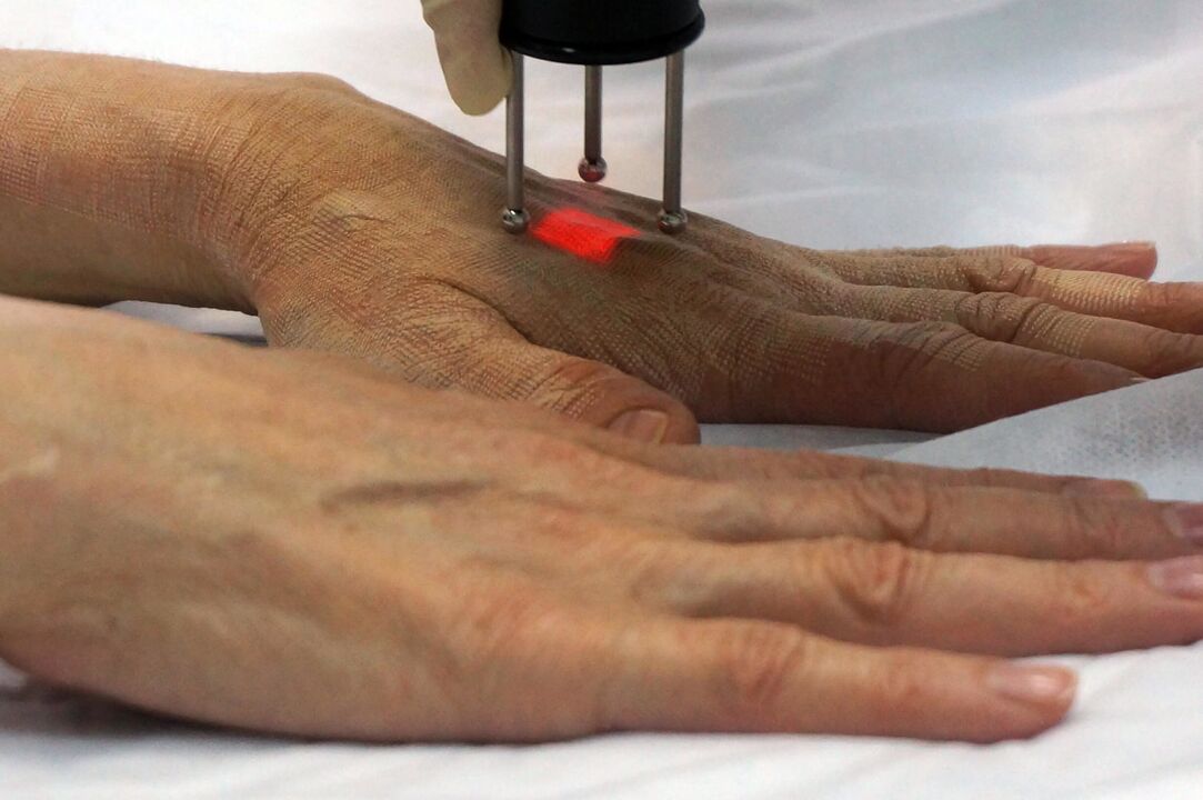 Laser hand rejuvenation using non-ablative methods