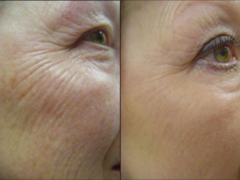 Before & After Laser Skin Rejuvenation - Visibly Reduces Wrinkles