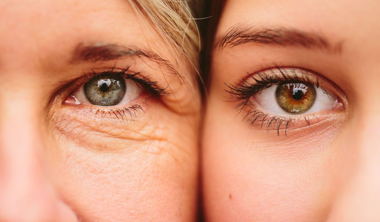 Signs of aging around the eyes