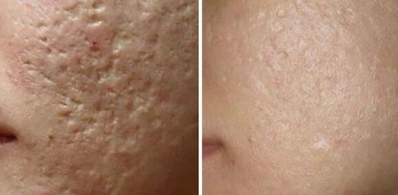 Laser polishing scars