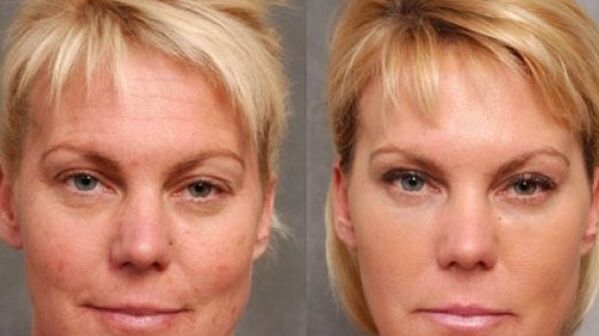 Before and after recovery program