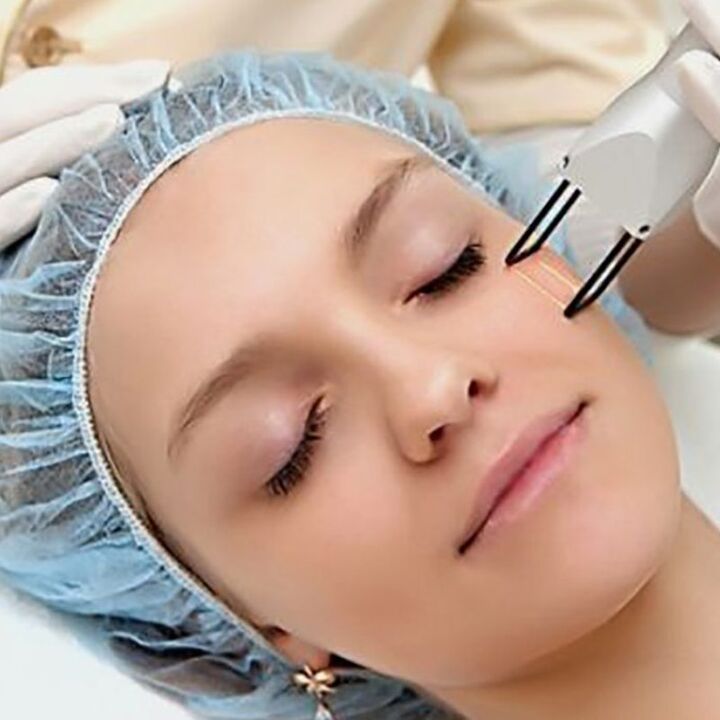 Laser fraction revival